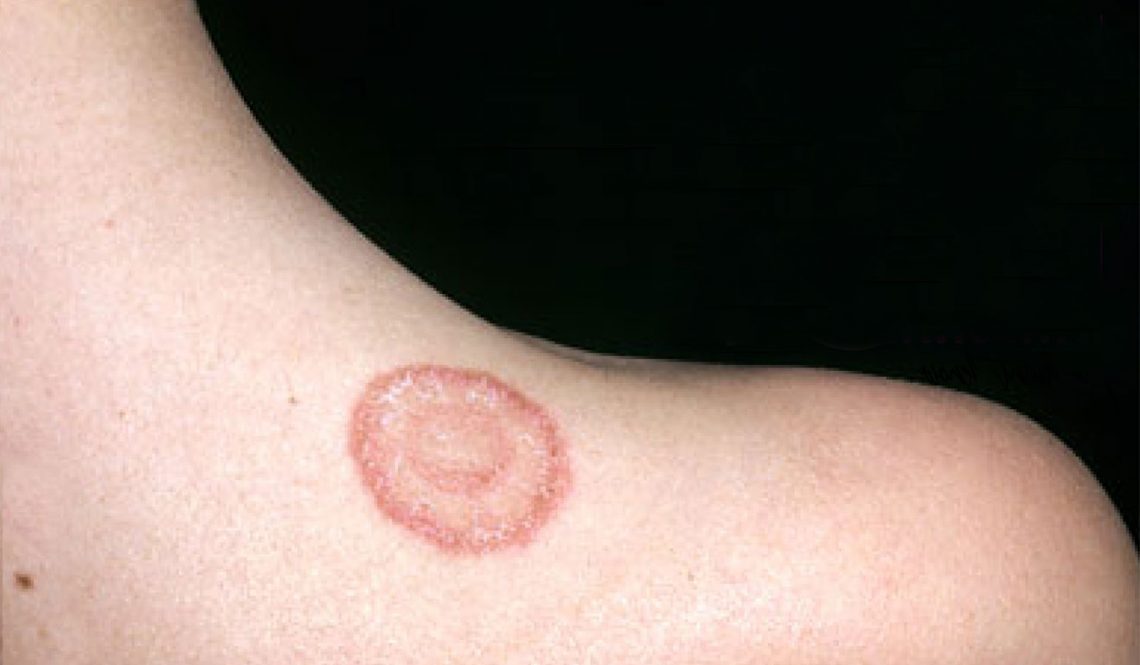 Natural Remedies To Treat Ringworm At Home - Wedandbeyond